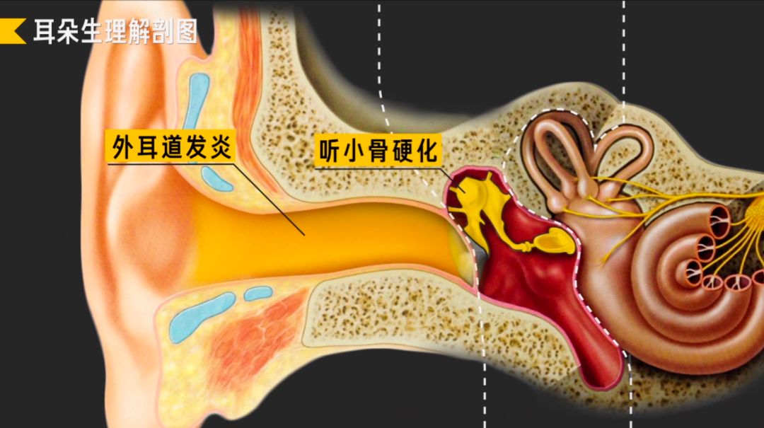 助听器如何拯救耳聋(图8)