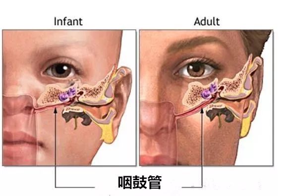 孩子听力下降,警惕分泌性中耳炎(图2)