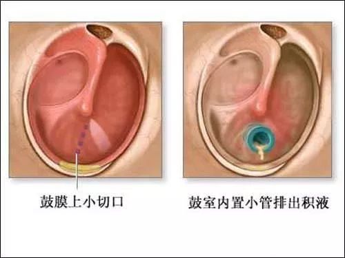 孩子听力下降,警惕分泌性中耳炎(图8)