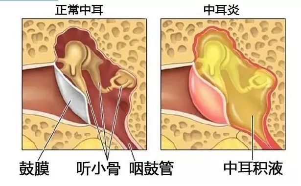 孩子听力下降,警惕分泌性中耳炎(图4)