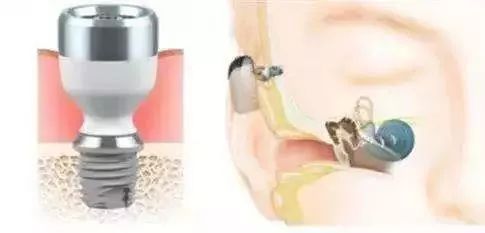 什么是骨导助听器?什么样的听力适合佩戴骨导助听器?(图5)